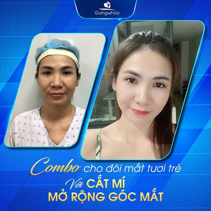 Lấy lại nét thanh xuân cho đôi mắt nhờ combo cắt mí & mở góc mắt