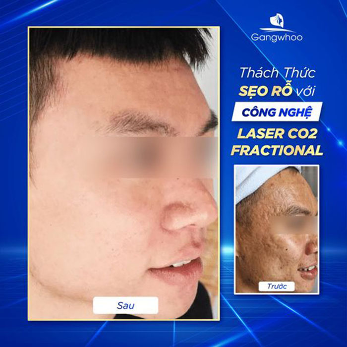 Điều trị sẹo rỗ bằng công nghệ siêu vi điểm laser fractional CO2 - Thách thức mọi vấn đề về sẹo