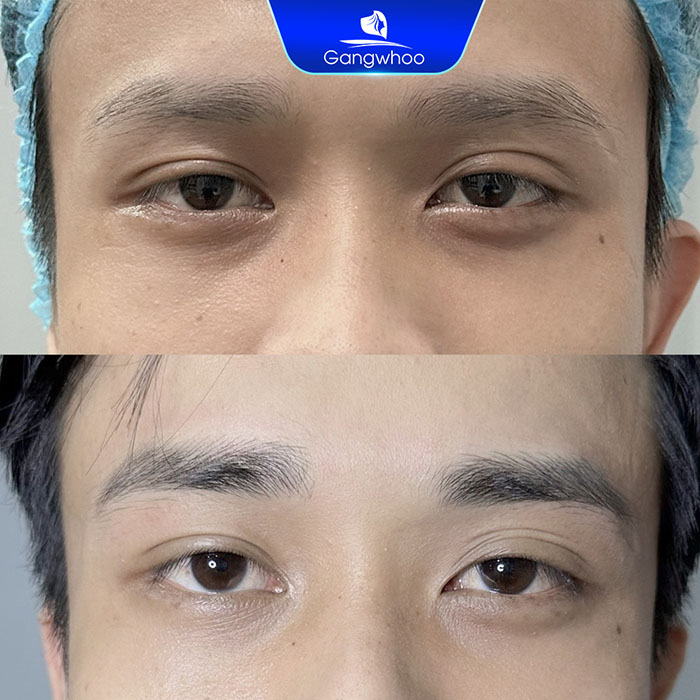 Điêu khắc chân mày 6D - Khắc phục tình trạng lông mày nhạt màu, thưa, 