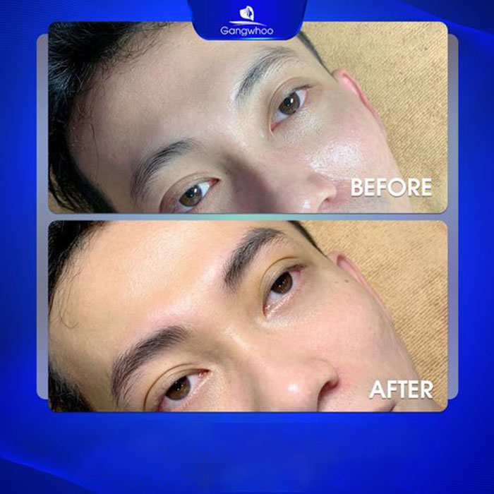 Có nên điêu khắc chân mày nam hay không do nhu cầu, mong muốn, quan niệm cá nhân của mỗi người.