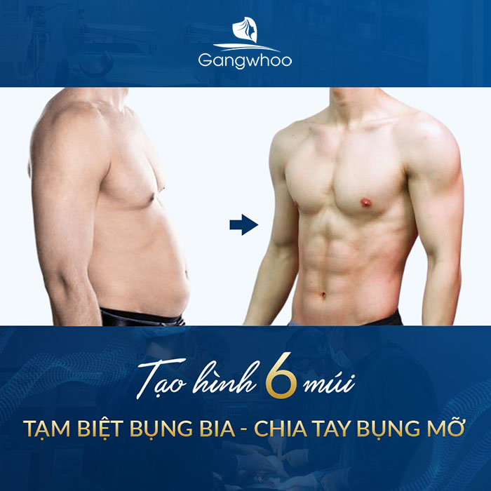 Phẫu thuật 6 múi là một phương pháp thẩm mỹ kết hợp giữa hút mỡ và phẫu thuật tạo hình cơ bụng.