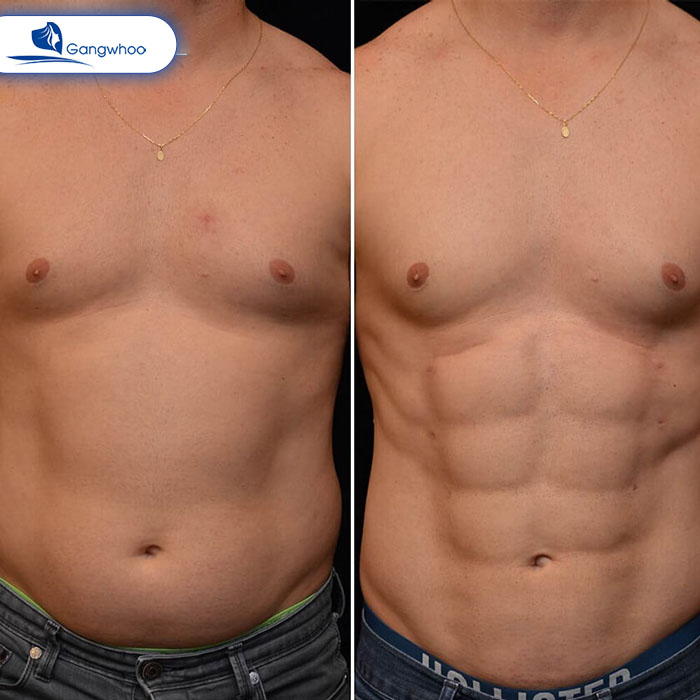 Thời gian hồi phục sau tạo bụng hình cơ bụng 6 múi phụ thuộc vào nhiều yếu tố