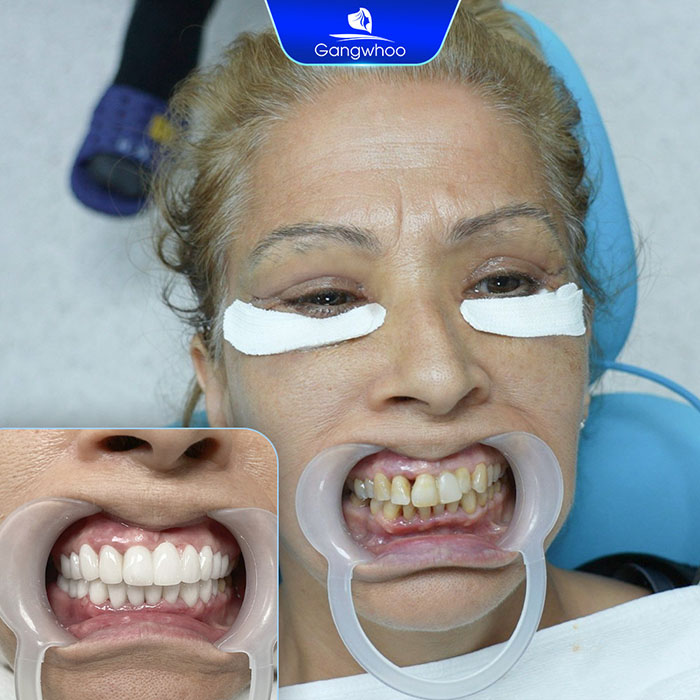 Trám răng cải thiện tối ưu răng bị sứt, mẻ, rưng bị vỡ, răng ngắn không đều