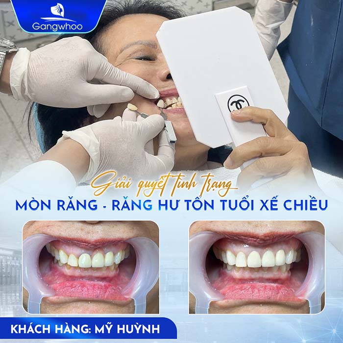 Trám Răng Cải Thiện Khuyết Điểm Răng Sứt Mẻ, Không Đều Nhau
