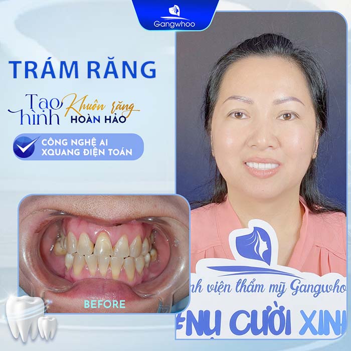 Trám răng không hề ảnh hưởng tới sức khỏe khách hàng