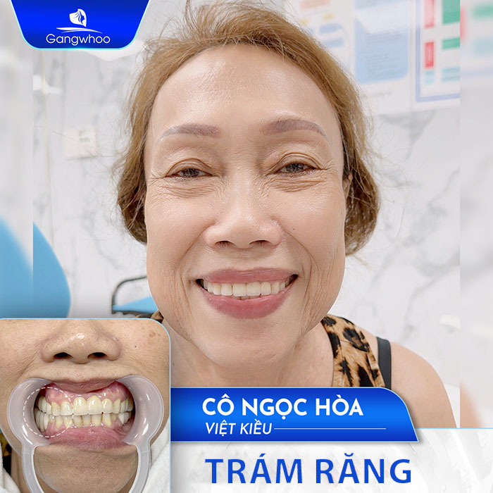 Bảo vệ răng hiệu quả 