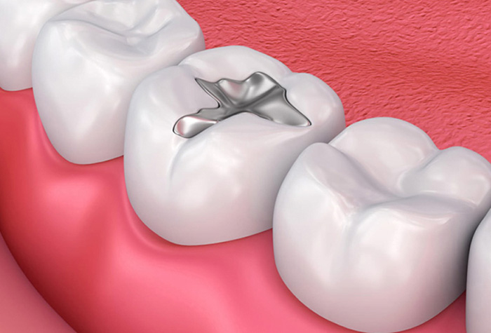 Vật liệu Amalgam được sử dụng phổ biến