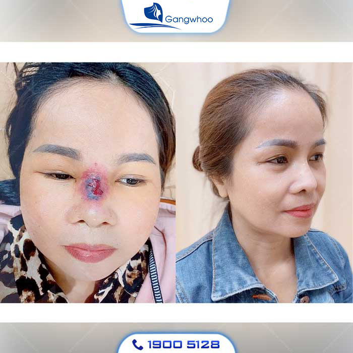 Nhiễm trùng là biến chứng nguy hiểm sau khi nâng mũi