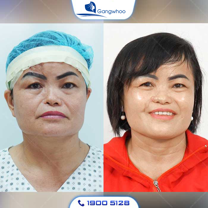 Sửa mũi hỏng có thể khắc phục cả các dáng mũi khiếm khuyết bẩm sinh