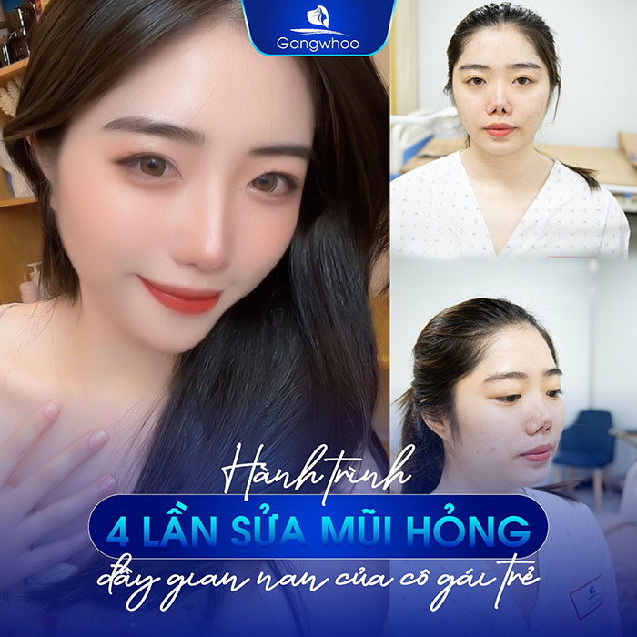 Thẩm mỹ viện Gangwhoo là cơ sở chỉnh sửa mũi hỏng uy tín tại TP Hồ Chí Minh.