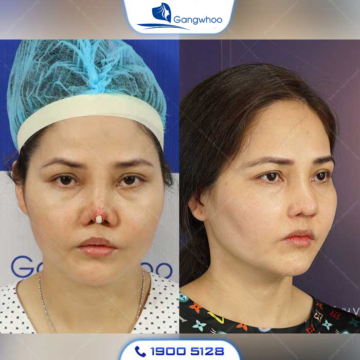 Mũi bị lộ sống dễ dàng nhìn thấy bằng mắt thường