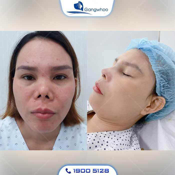 Đầu mũi bị co rút khiến mũi bị hếch