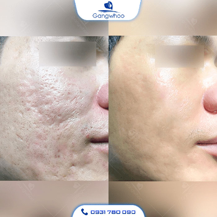 Dứt điểm sẹo rỗ sau 1 liệu trình