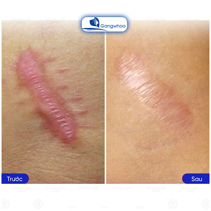 Điều trị sẹo lồi hiệu quả đặc trị lên đến 90% sau 1 liệu trình