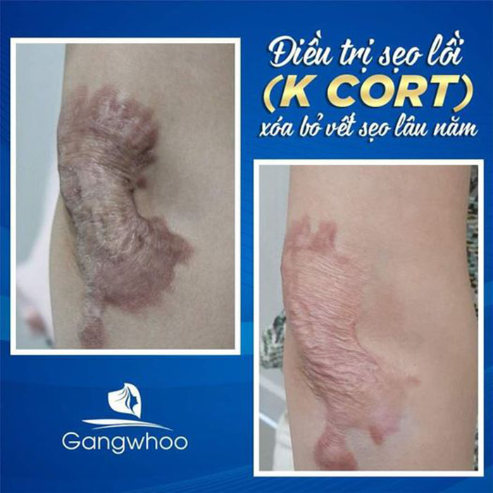 Đánh tan sẹo lồi – nỗi lo âu trong cuộc sống với điều trị sẹp lồi K Cort