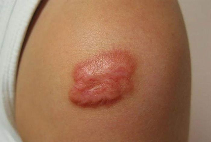 Điều trị sẹo lồi K Cort hiệu quả cho sẹo lồi từ nhẹ đến nặng.