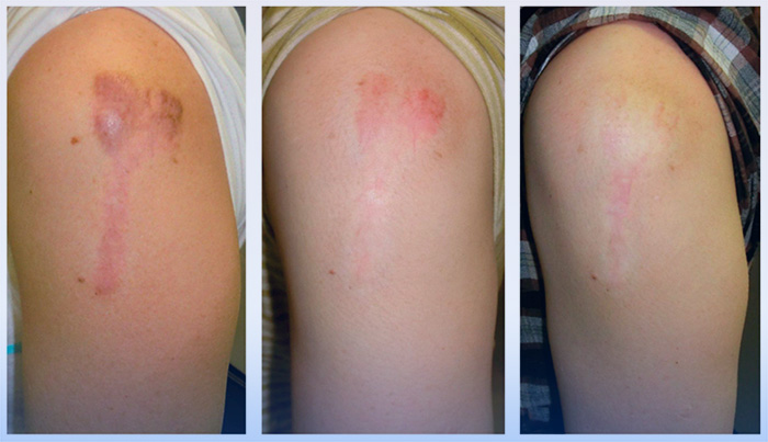 Kiên trì điều trị sẹo lồi theo đúng phác đồ do bác sĩ chỉ định để đảm bảo hiệu quả tối ưu