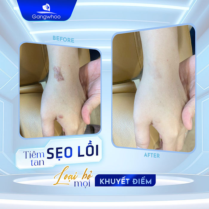 Điều Trị Sẹo Lồi K Cort - Xóa Bỏ Vết Sẹo Lâu Năm