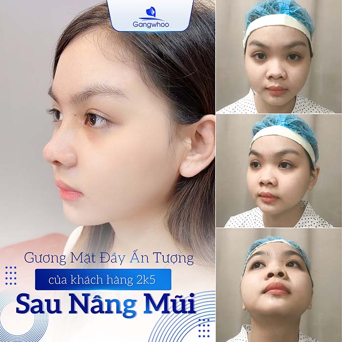 Mũi đẹp chuẩn tỷ lệ sau 1 tháng nâng mũi