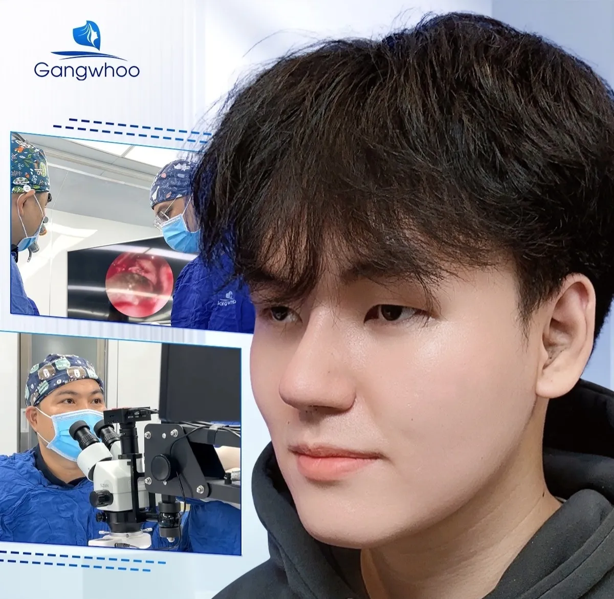 Gangwhoo còn ứng dụng kỹ thuật vi phẫu tiên tiến trong nâng mũi