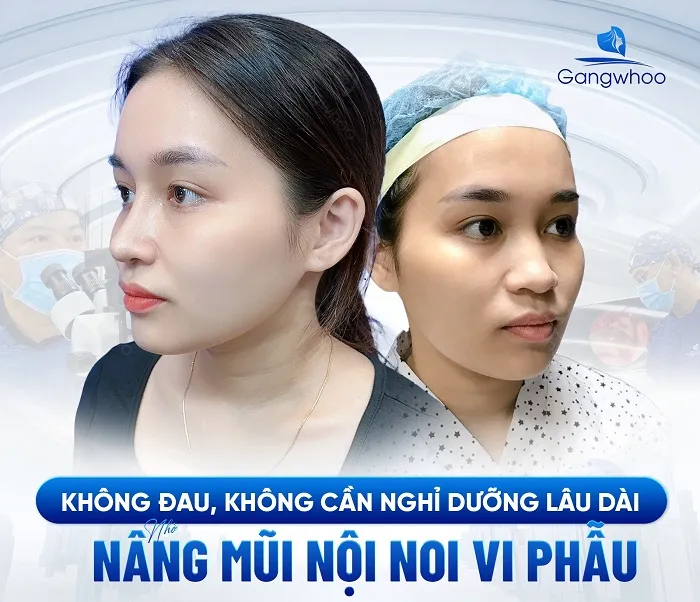 Rút ngắn thời gian hồi phục sau khi nâng mũi với công nghệ hiện đại