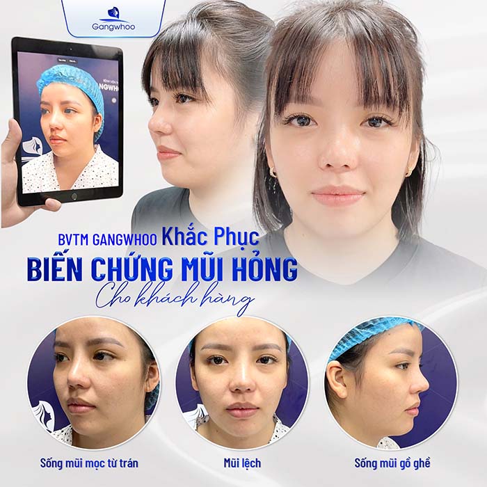 Nâng mũi sụn sườn - Giải pháp hoàn hảo cho tình trạng mũi hỏng