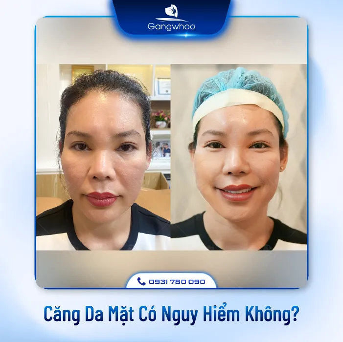 Căng Da Mặt Có Nguy Hiểm Không? 4 Rủi Ro Có Thể Xảy Ra