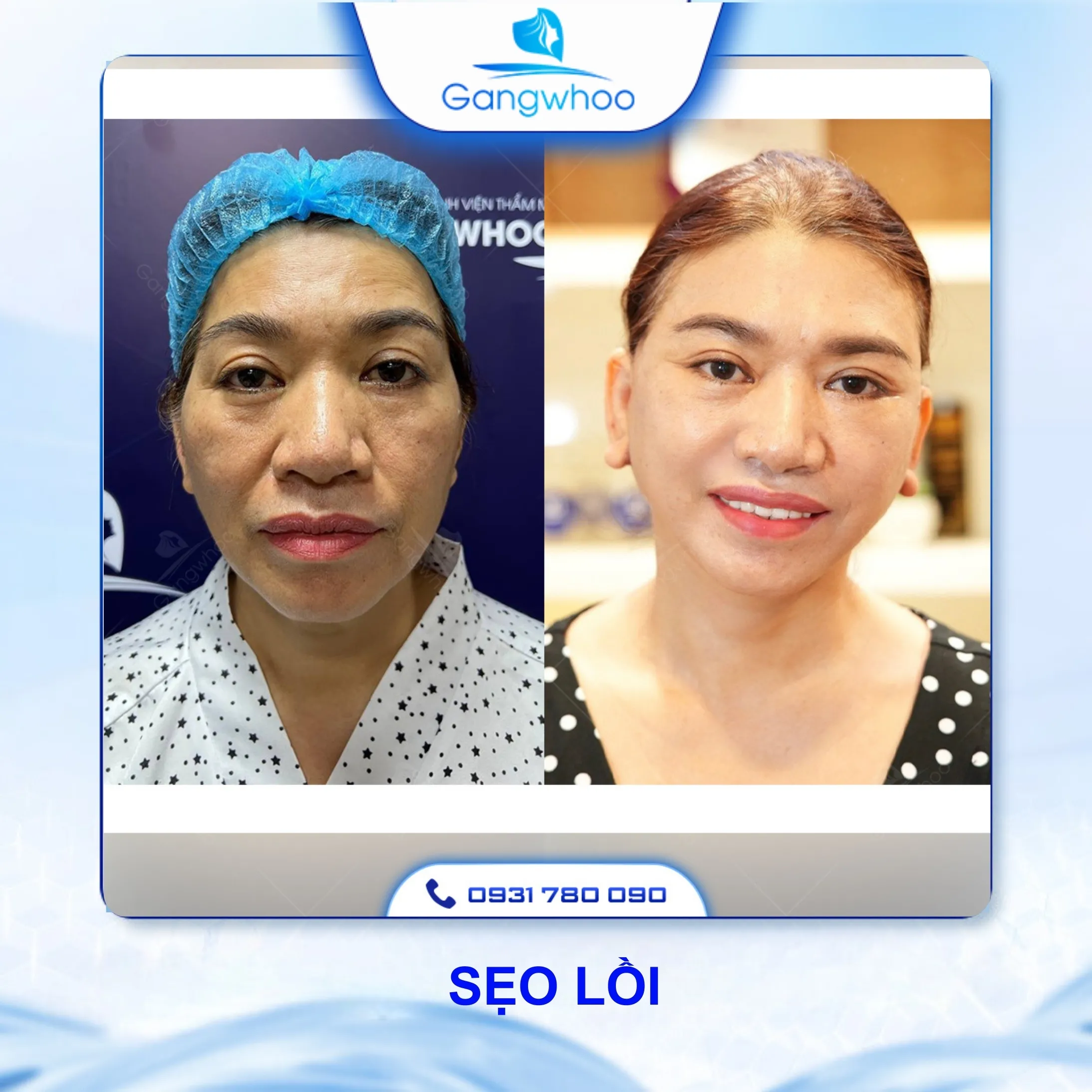 Căng Da Mặt Có Nguy Hiểm Không? 4 Rủi Ro Có Thể Xảy Ra