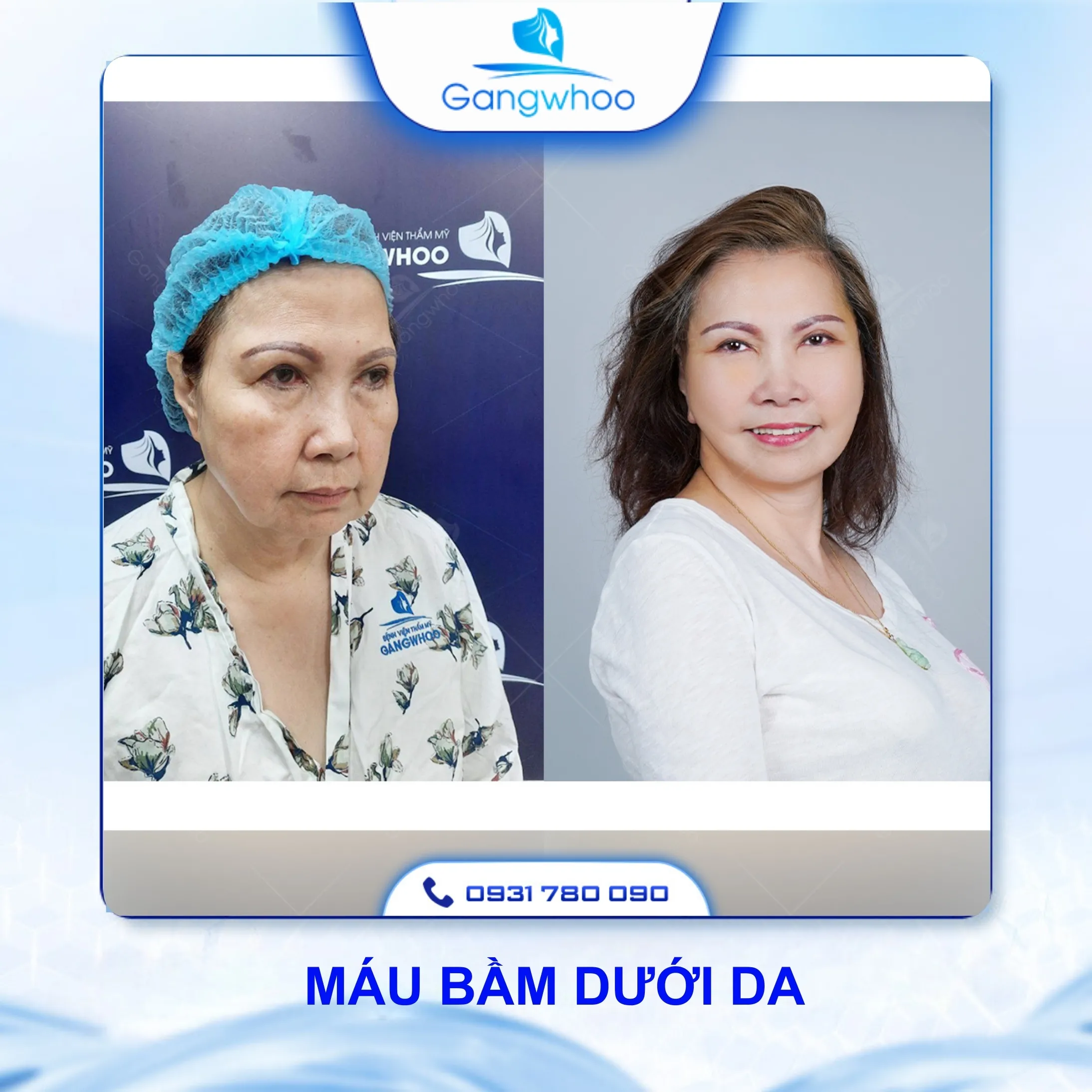 Căng Da Mặt Có Nguy Hiểm Không? 4 Rủi Ro Có Thể Xảy Ra