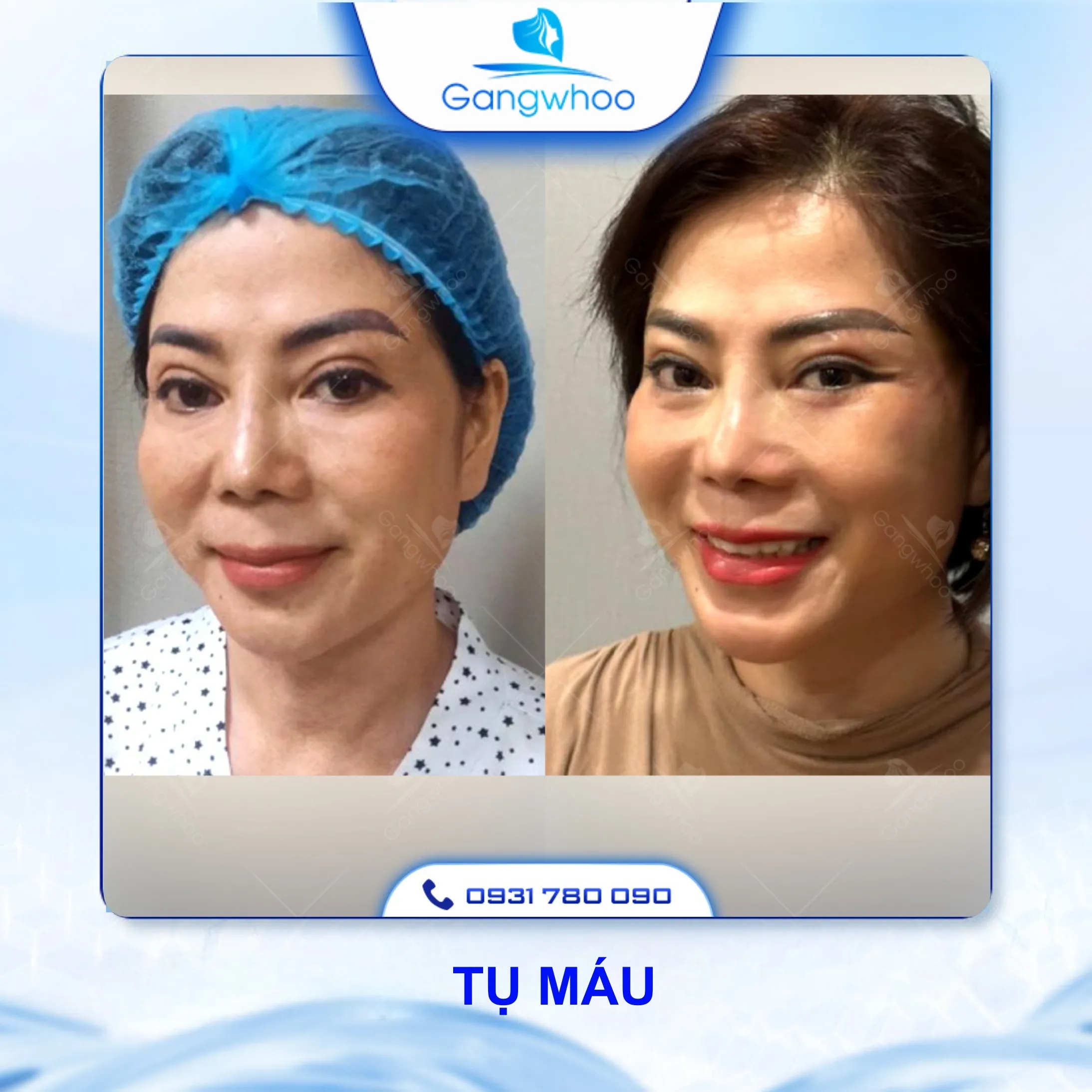 Căng Da Mặt Có Nguy Hiểm Không? 4 Rủi Ro Có Thể Xảy Ra