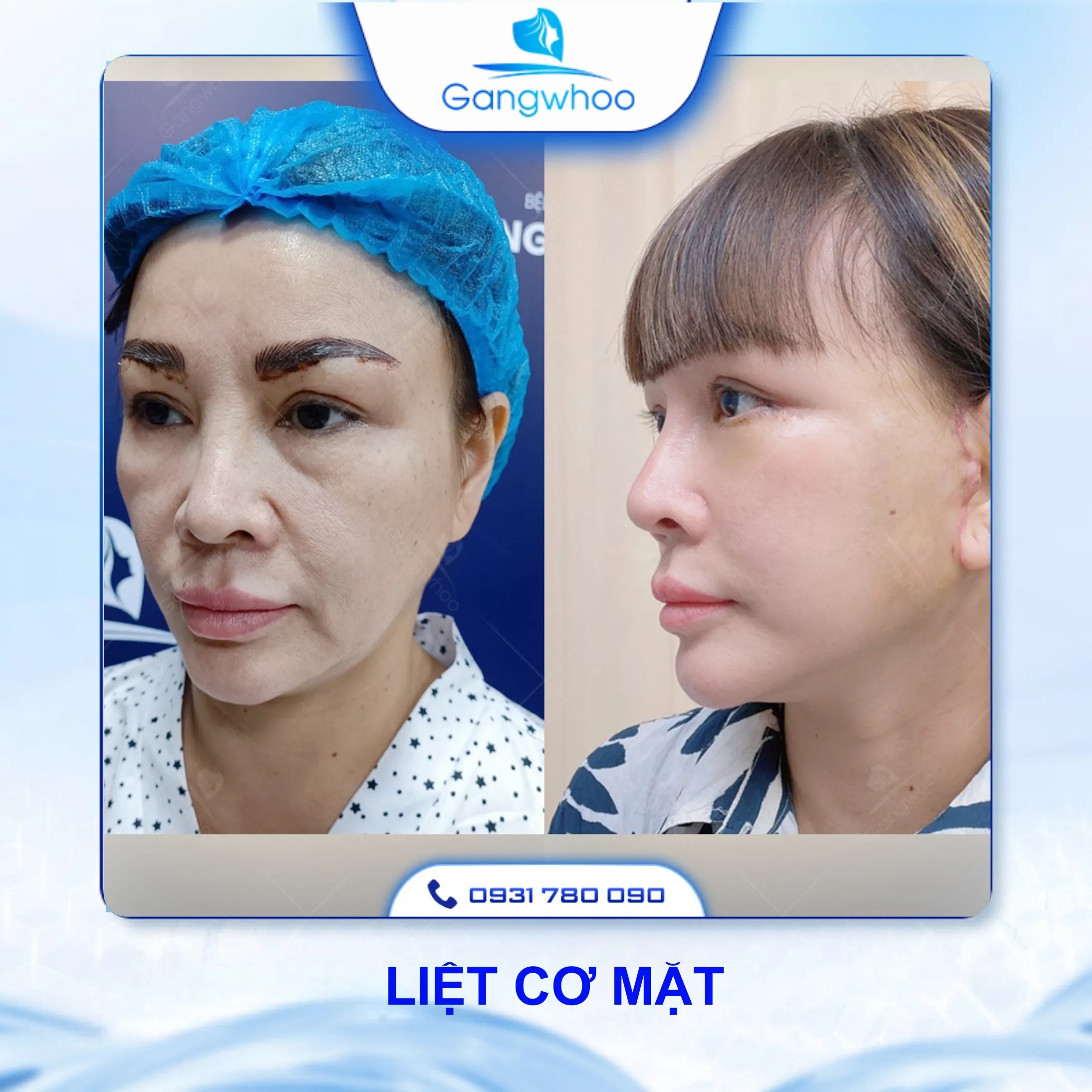 Căng Da Mặt Có Nguy Hiểm Không? 4 Rủi Ro Có Thể Xảy Ra