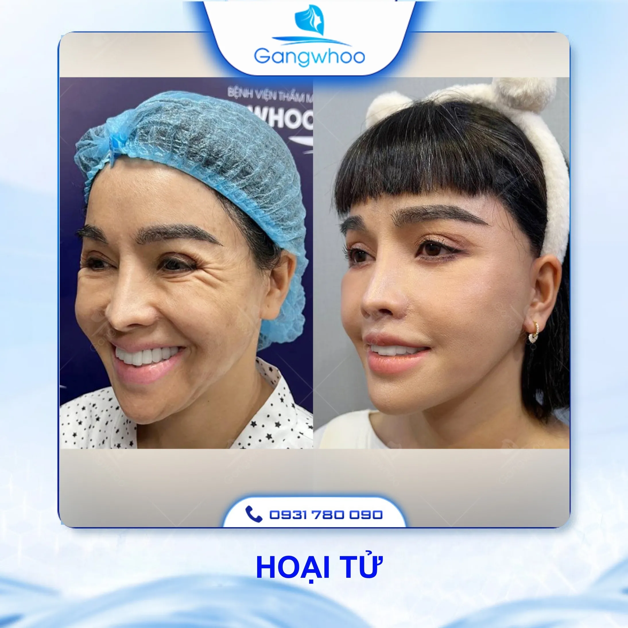 Căng Da Mặt Có Nguy Hiểm Không? 4 Rủi Ro Có Thể Xảy Ra