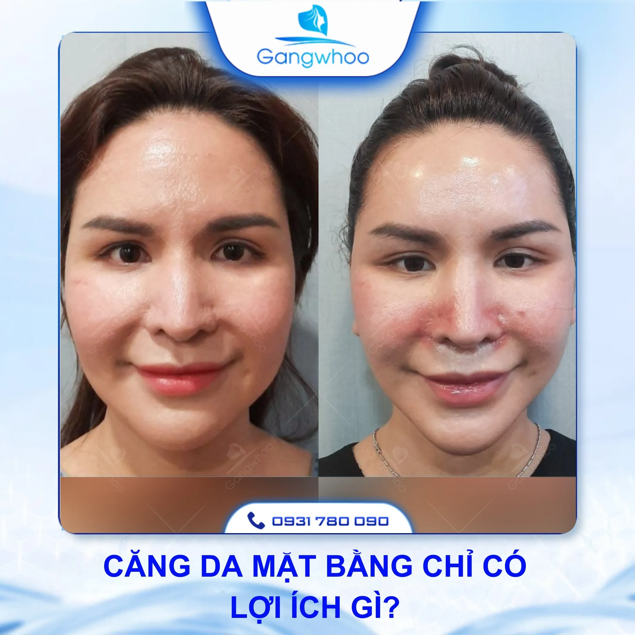 Gợi Ý Cách Chăm Sóc Sau Khi Căng Da Mặt Bằng Chỉ