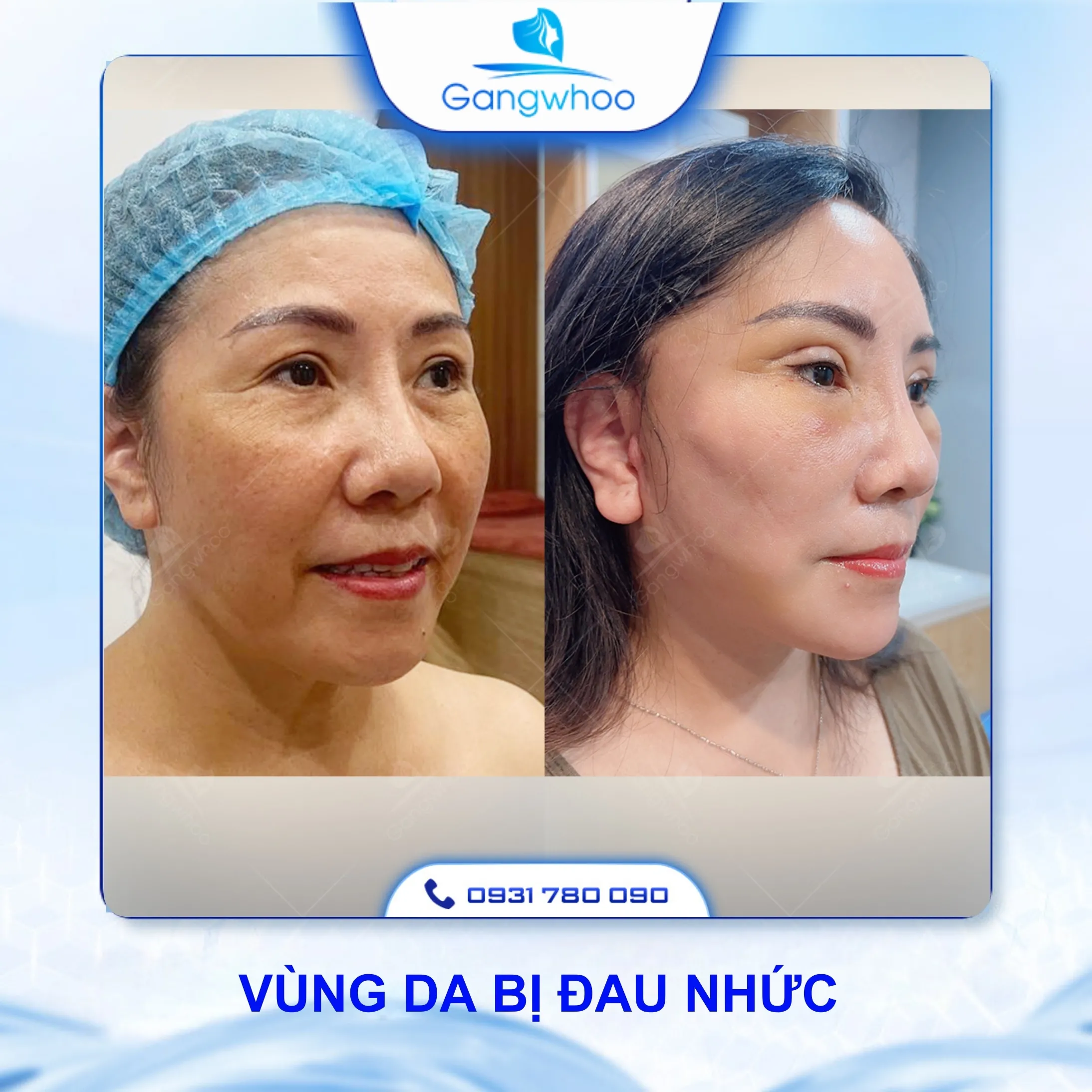 Gợi Ý Cách Chăm Sóc Sau Khi Căng Da Mặt Bằng Chỉ