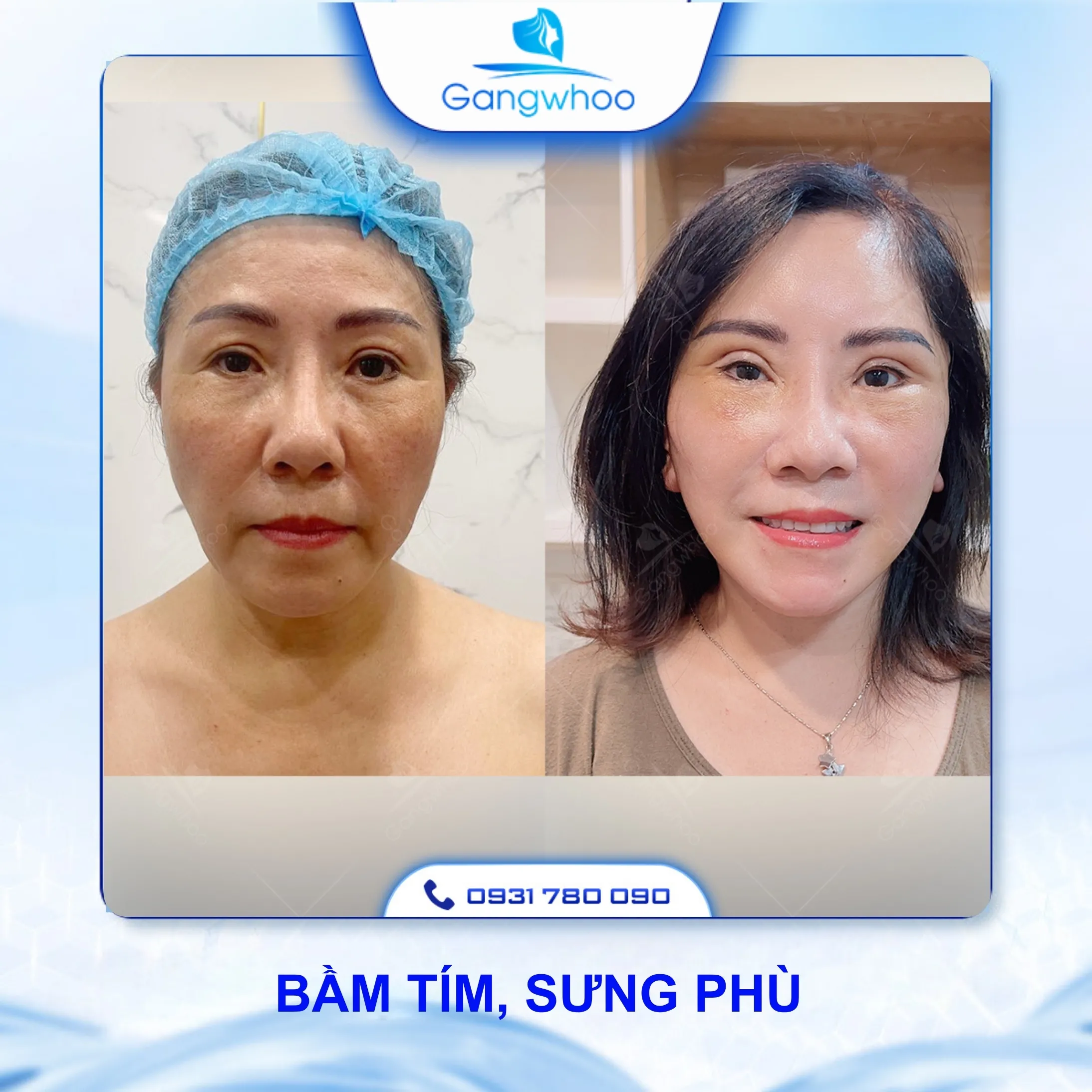 Gợi Ý Cách Chăm Sóc Sau Khi Căng Da Mặt Bằng Chỉ