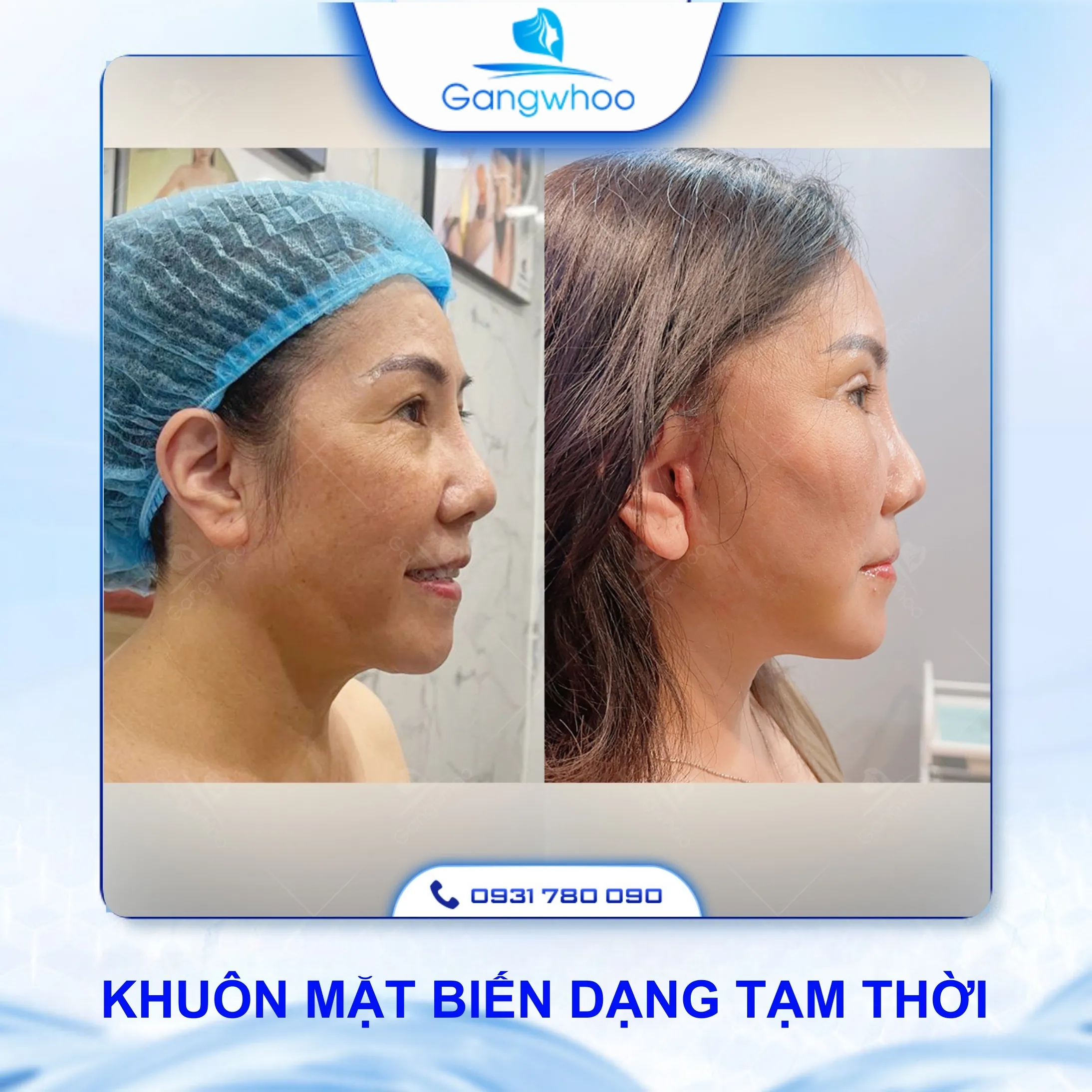 Gợi Ý Cách Chăm Sóc Sau Khi Căng Da Mặt Bằng Chỉ