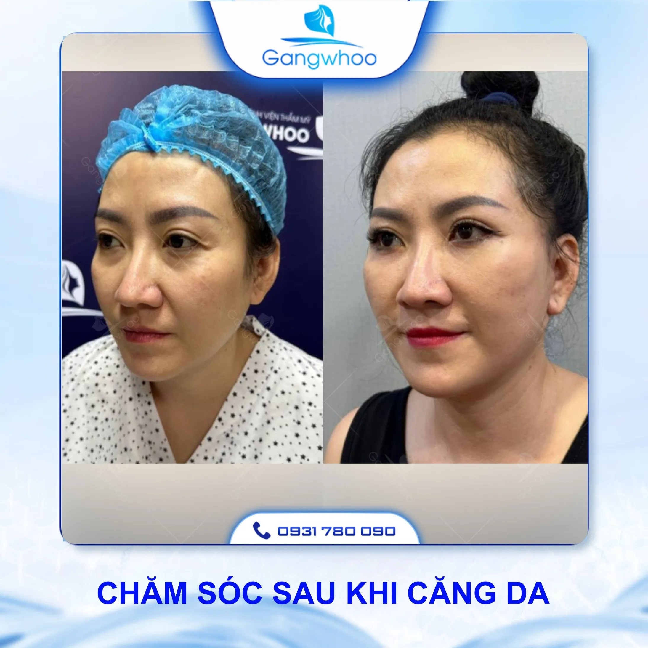 Gợi Ý Cách Chăm Sóc Sau Khi Căng Da Mặt Bằng Chỉ