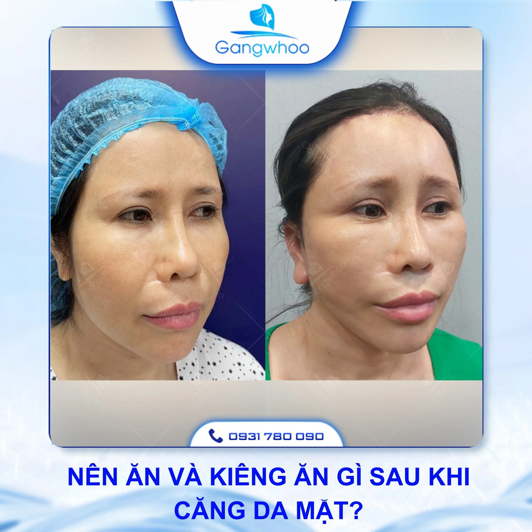 Gợi Ý Cách Chăm Sóc Sau Khi Căng Da Mặt Bằng Chỉ