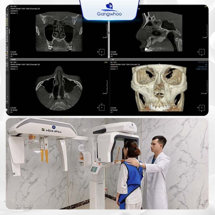 Ứng dụng công nghệ X-Quang AI điện toán vào nâng mũi