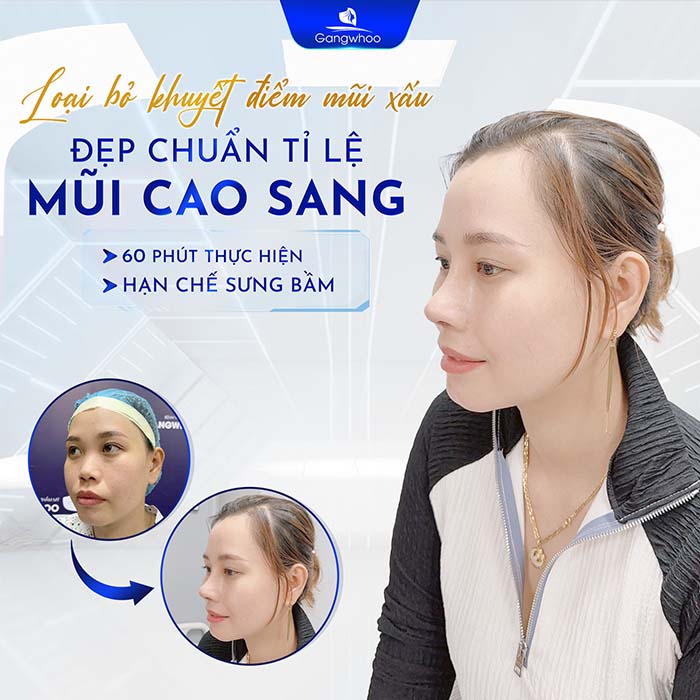 Mũi cao sang đẹp chuẩn tỷ lệ