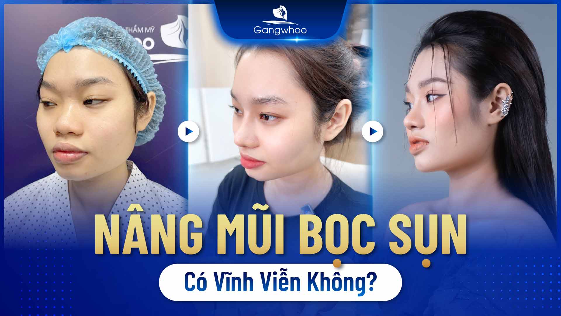 Nâng mũi bọc sụn có thể duy trì lên đến 20 năm