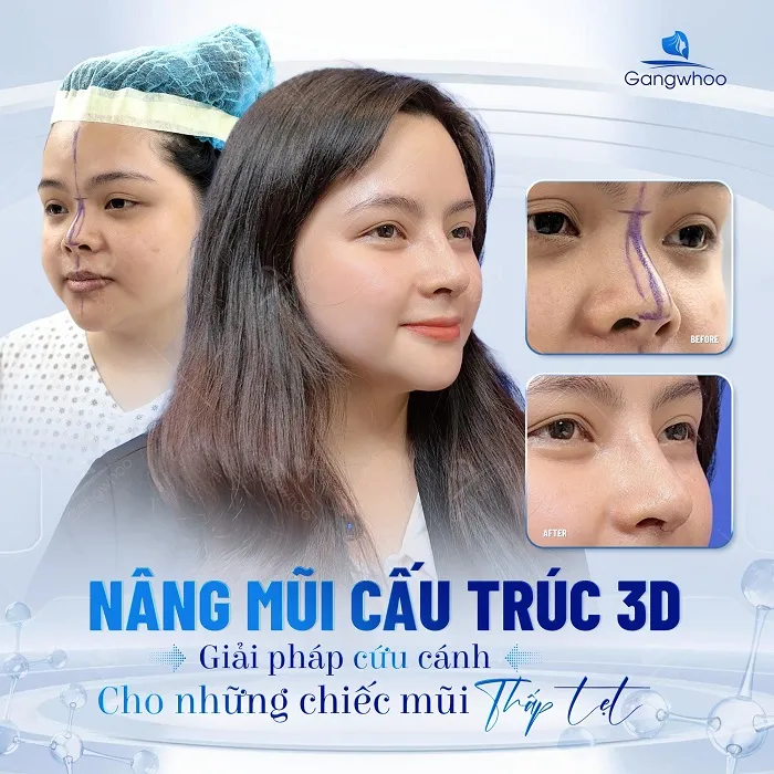 Chọn địa chỉ nâng mũi cấu trúc uy tín, chất lượng