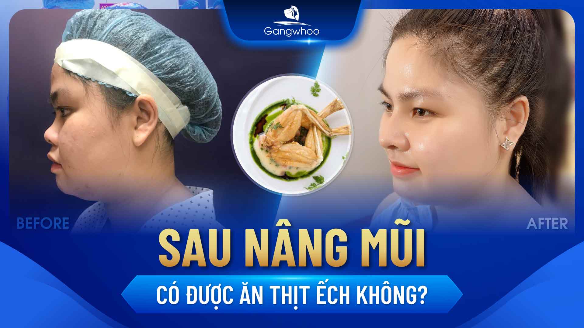 Sau Nâng Mũi Có Được Ăn Thịt Ếch Không?