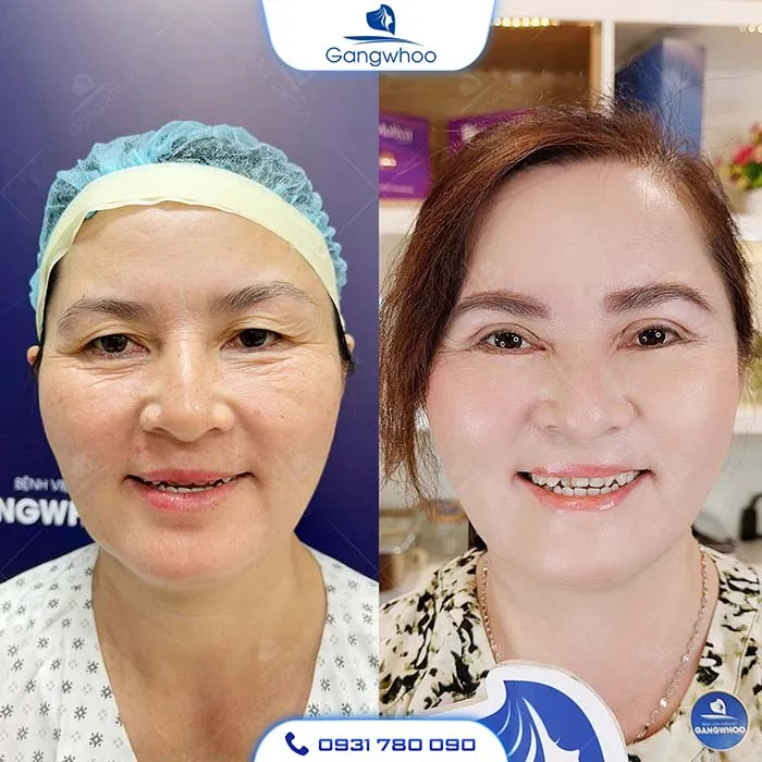 Top 5 Bệnh Viện Thẩm Mỹ Căng Da Mặt Uy Tín Tại TP. HCM