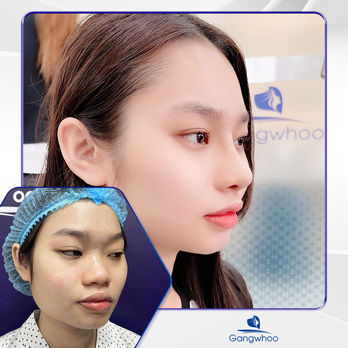 Mũi đẹp tự nhiên sau 1 tháng nâng mũi