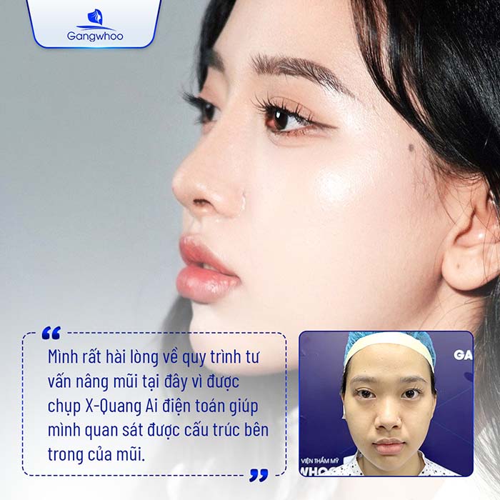 TMV Gangwhoo ứng dụng công nghệ X-Quang AI điện toán vao thẩm mỹ mũi