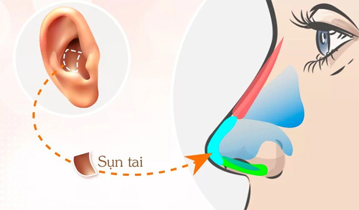 Nâng mũi bọc sụn là phương pháp thẩm mỹ kết hợp 2 loại sụn nâng mũi là sụn sinh học và sụn tự thân