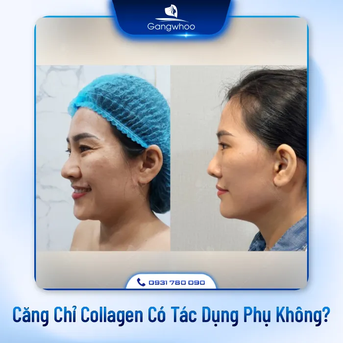 Căng Da Mặt Có Tác Dụng Phụ Không? 3 Cách Đảm Bảo An Toàn