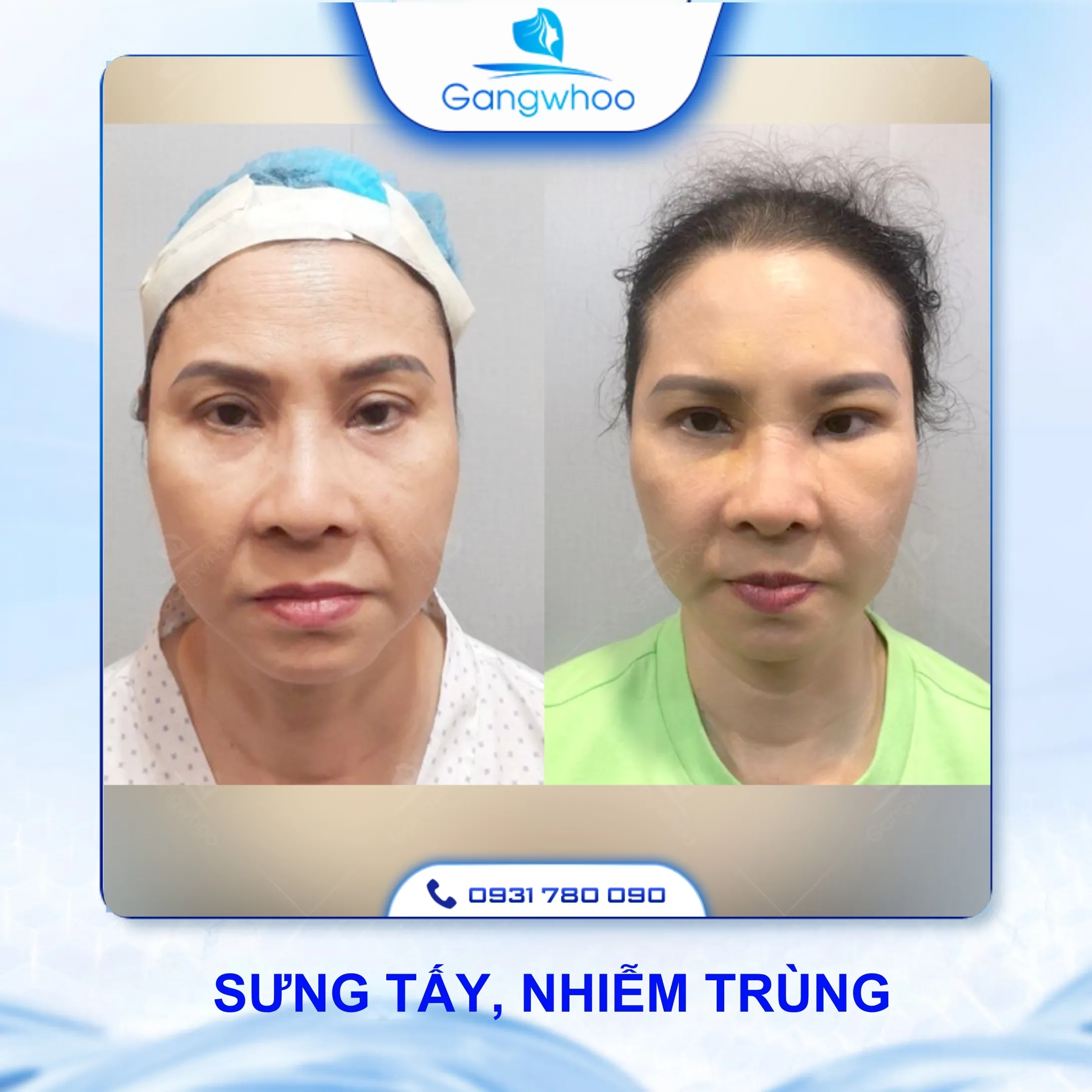 Căng Da Mặt Có Tác Dụng Phụ Không? 3 Cách Đảm Bảo An Toàn