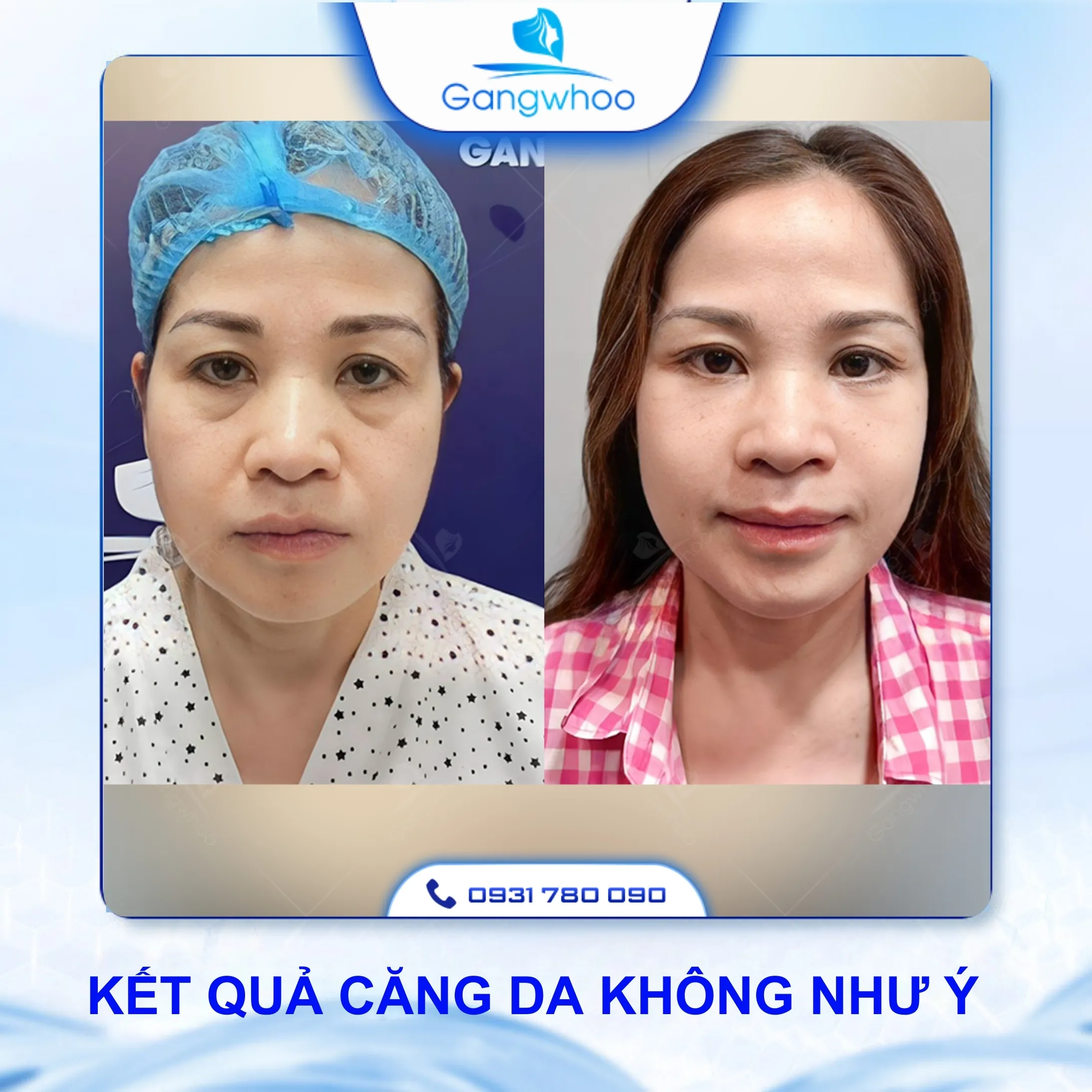 Căng Da Mặt Có Tác Dụng Phụ Không? 3 Cách Đảm Bảo An Toàn